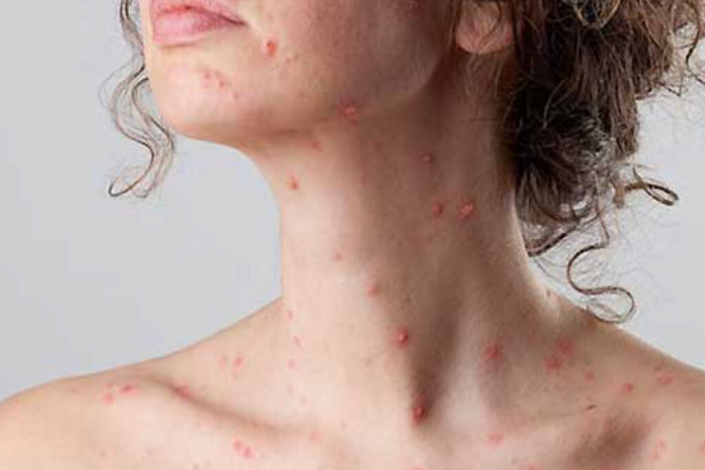 SADE Blog herpes zoster