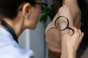 SADE Blog Cancer de piel