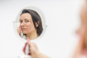 SADE Blog Acne persistente en adultos