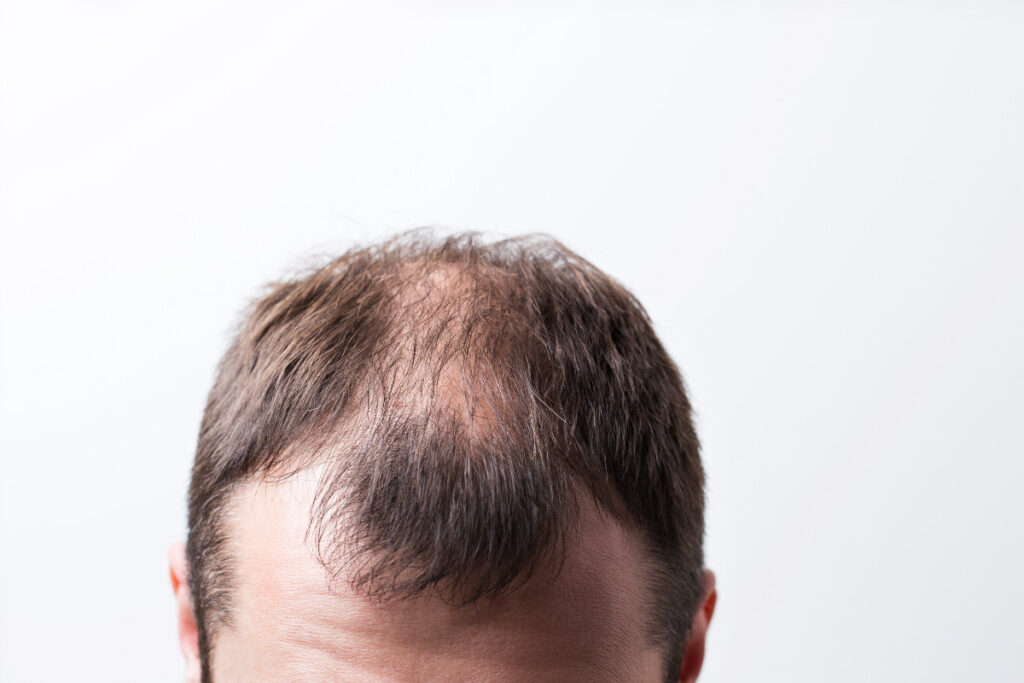 SADE Blog Alopecia