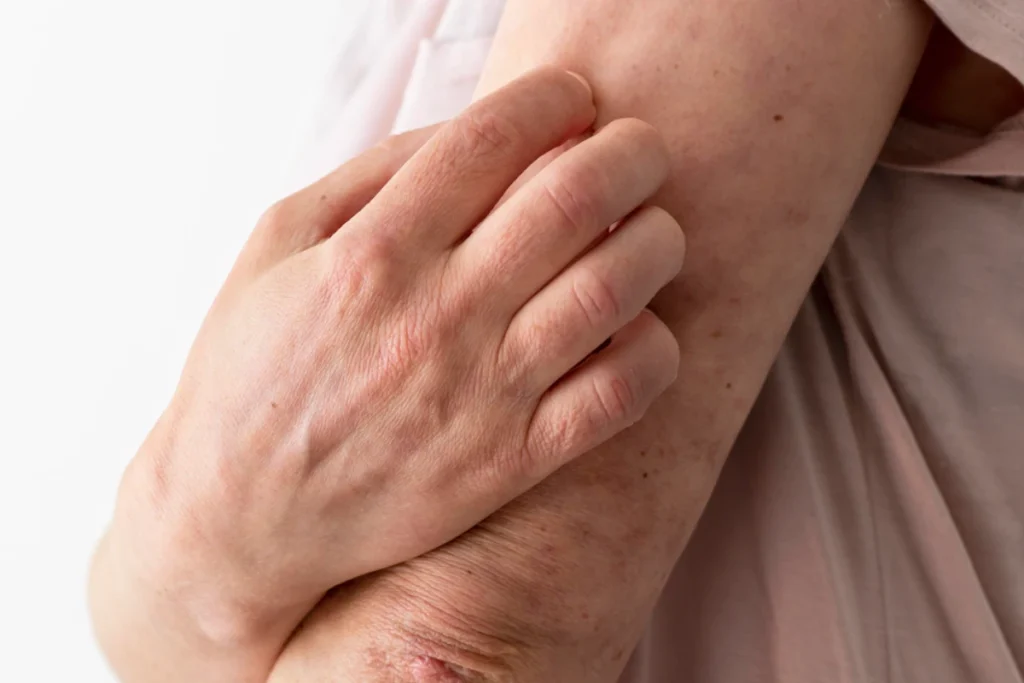 Dermatólogo examinando reacción de dermatitis de contacto en la piel del brazo de un paciente