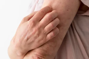 Dermatólogo examinando reacción de dermatitis de contacto en la piel del brazo de un paciente