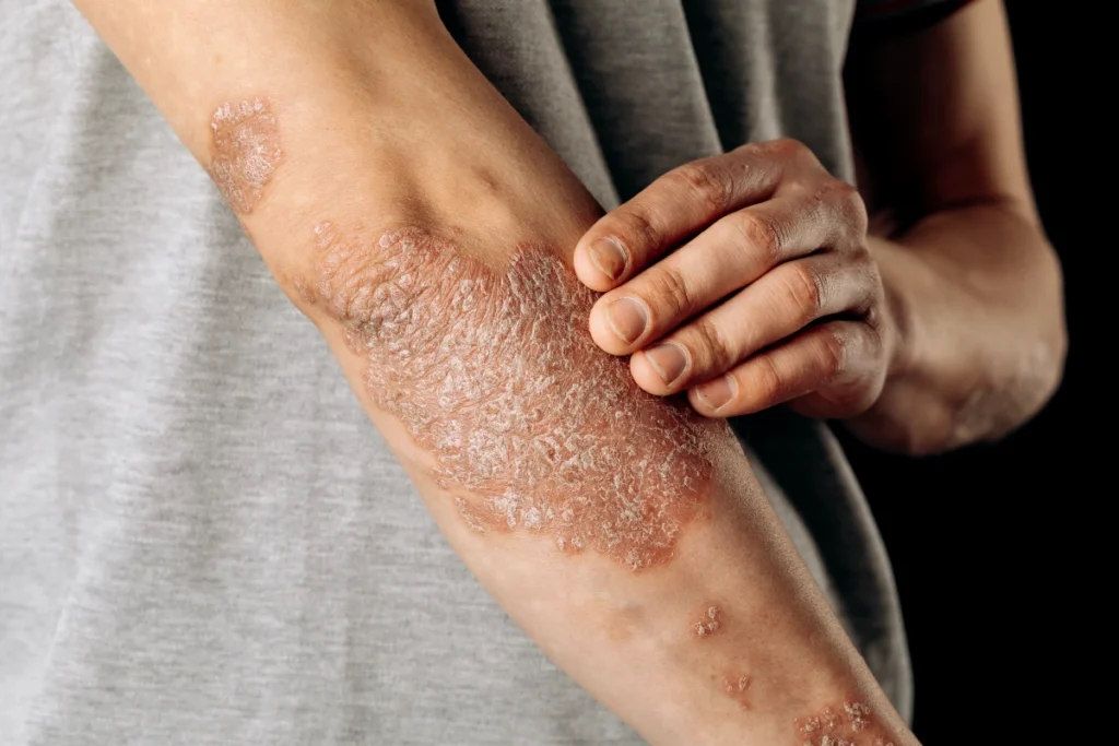 Placas de psoriasis en la piel del codo de un paciente durante una consulta dermatológica