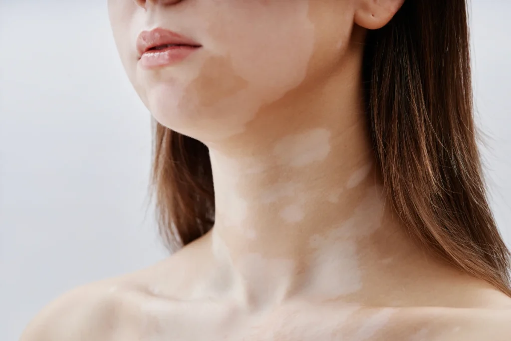 Dermatólogo evaluando manchas de vitíligo en la piel del brazo de un paciente con lámpara de Wood